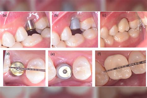 Uprighting A Mesially Tilted Molar Using Customized Titanium Healing
