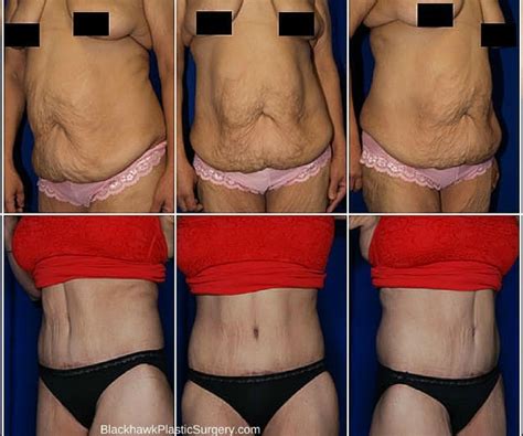 Messy to minimal recap watch the rest. Top 7 Plastic Surgery Procedures for Extreme Weight Loss ...