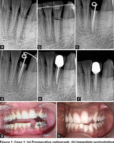 Figure 1 From Management Of Subgingival Root Fracture With Decoronation