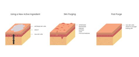 What You Should Know About Skin Purging Sabbia Co