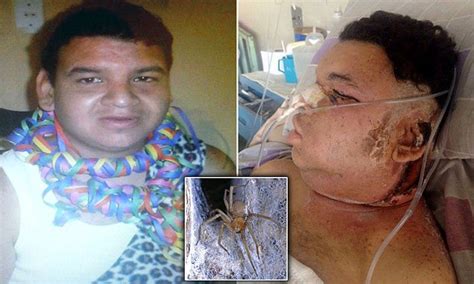 Camel spiders have become famous since the beginning of the 2000s, when the first american soldiers entered iraq. Chilean Recluse spider bite leaves man fighting for life ...