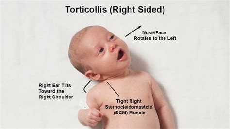 congenital torticollis management pediatric practice… pearls for your pediatric office practice