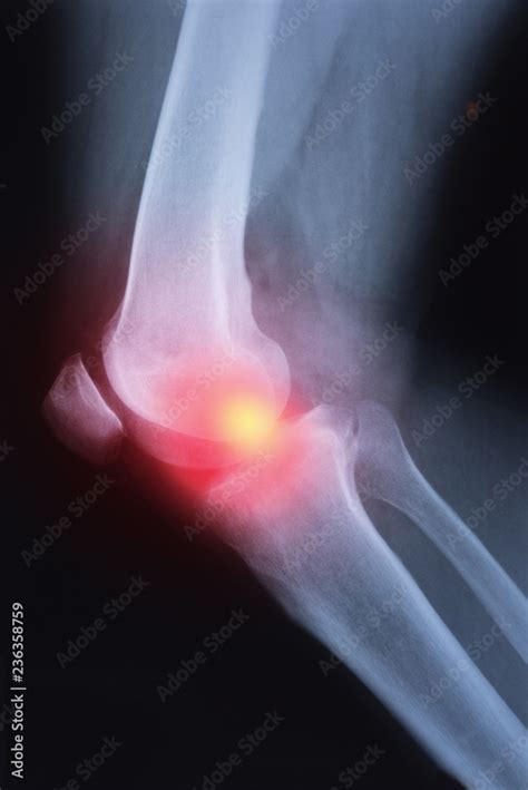 Medical X Ray Knee Joint Image With Arthritis Gout Rheumatoid