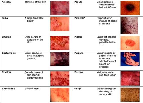 49 Best Staph Infection Images On Pinterest