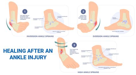 How To Heal A Ankle Injury Using Sprain Ankle Treatment