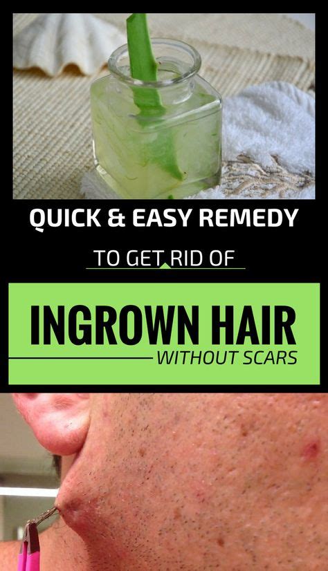 Improve Your Skin With These Great Tips Ingrown Hair Remedies