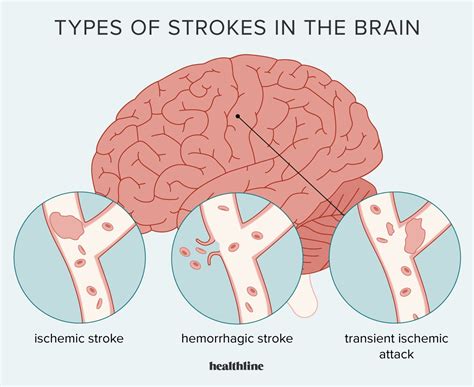 😱 Introduction Stroke Essay Stroke The Causes And Effects Health And