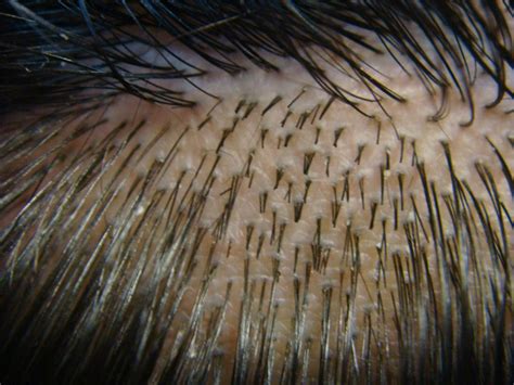 View Of Scalp Hair Demonstrating Follicular Units These Are Naturally