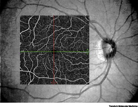 Optical Coherence Tomography Angiography A Window Into Central Nervous