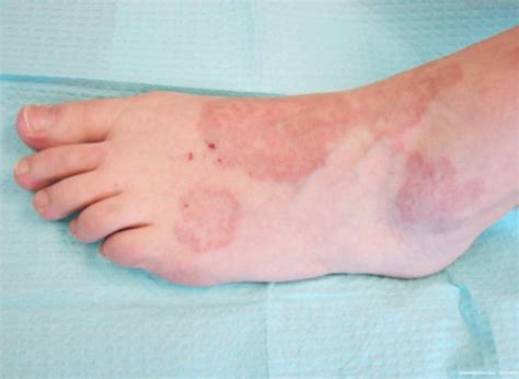 Granuloma Annulare Feet