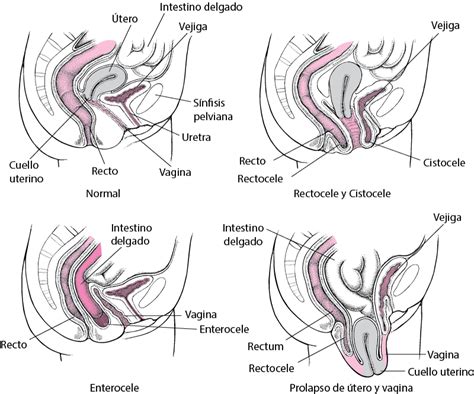 generalidades sobre el prolapso de órganos pélvicos ginecología y obstetricia manual msd