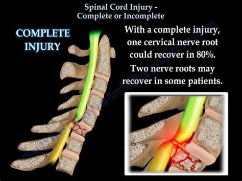 Spinal Cord Injury Complete Or Incomplete Everything You Need To Know