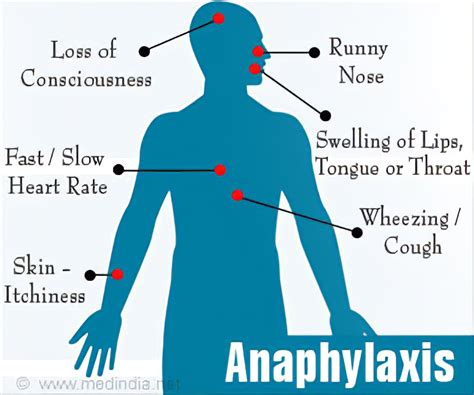 Anaphylaxis is a potentially life threatening, severe allergic reaction and should always be treated as a medical emergency. Anaphylaxis / Anaphylaxis Health24 / Read about ...
