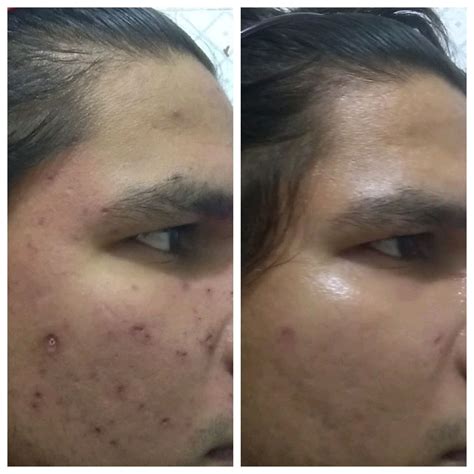 Chicken Pox Scars After Excisionwhat Next Scar Treatments