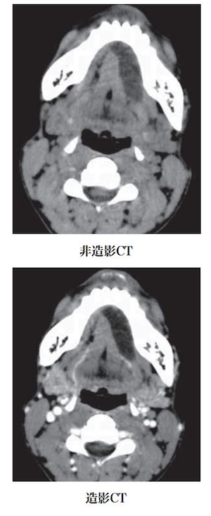 ガマ腫の画像診断