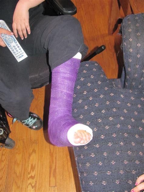 Kates Blog A Trip To The Fracture Clinic And A New Purple Cast