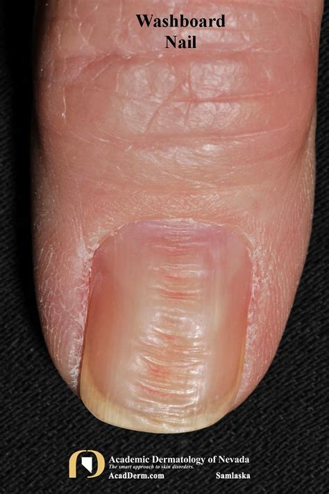 Nail Trauma Washboard Nails Nail Biting Academic Dermatology Of