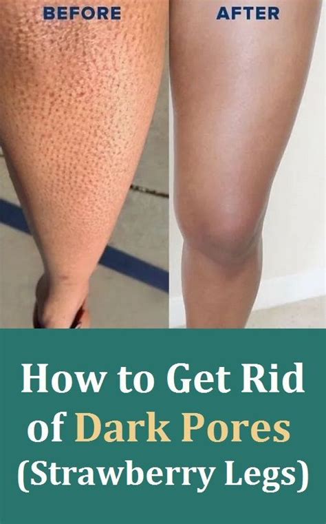 How do you permanently remove unwanted hair? How to Get Rid of Dark Pores (Strawberry Legs) in 2020 ...