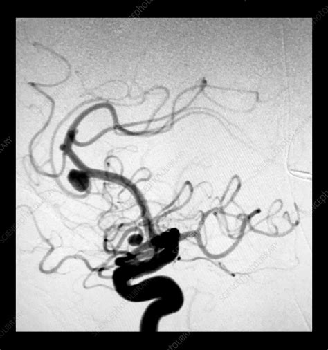 Anterior Cerebral Artery Aneurysm Angiogram Stock Image C Science Photo Library