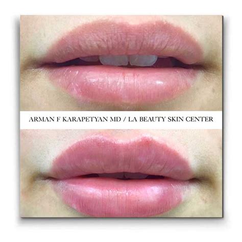 Temporary Lip Fillers Get Fuller Lips La Beauty Skin Center