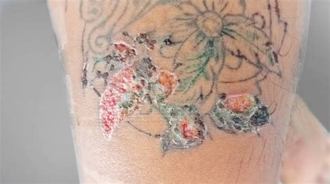 7 Skin Reactions To Tattoos Springs Dermatology Md