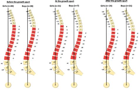 Exact Vertebral Inclination In The Sagittal Plane In Boys And Girls In