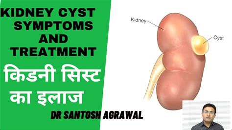 Kidney Cyst Treatment I Renal Cyst I Kidney Ki Gathan Youtube