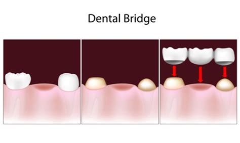 how many teeth can you realistically replace using a dental bridge