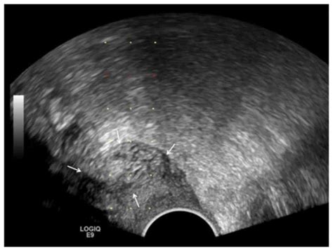 Transvaginal Transrectal Ultrasound Guided Aspiration Biopsy For
