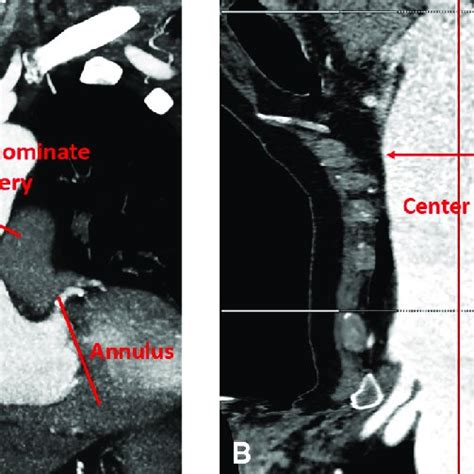 Measuring Ascending Aortic Geometry From Computed Tomography Scans