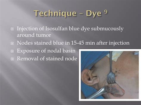 Ppt Role Of Sentinel Lymph Node Biopsy In Head And Neck Cancer