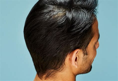 Update More Than 66 Crown Hair Loss Best Ineteachers