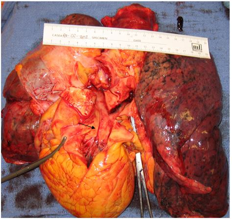 Pulmonary embolism (pe) is the obstruction of one or more pulmonary arteries by solid, liquid, or gaseous masses. Contemporary Surgical Management of Acute Massive ...