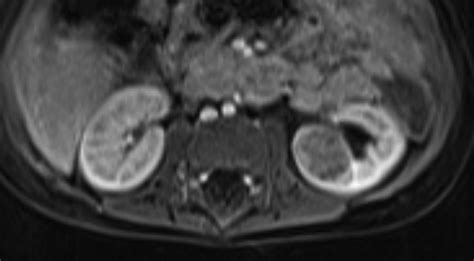 Imaging Characteristics Of Nephrogenic Rests Versus Small Wilms Tumors