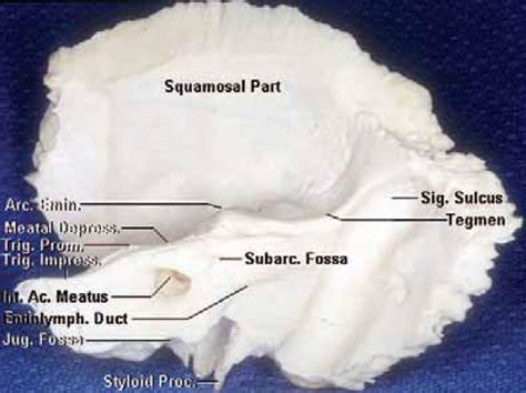 Oblique Posterior View Of Right Temporal Bone Neuroanatomy The