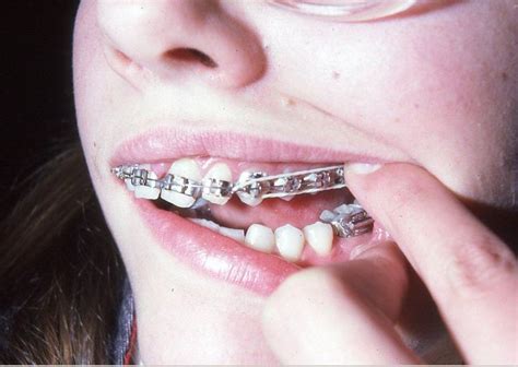 Full Banded Braces 1980s Dental Braces Orthodontics Braces Braces Rubber Bands
