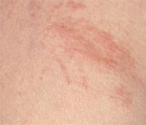 Rash On The Crease Where Buttocks Meets Legs Itchy And Stings R Diagnoseme