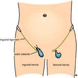The groin is the area that lies between the abdomen stomach and thighs. Femoral Hernia - Holistic Hernia Remediation