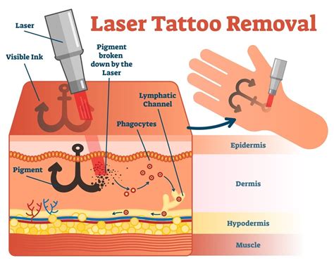 How To Remove Tattoo At Home In 2023 Top Removal Methods