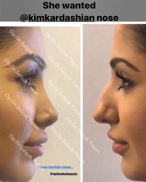 Vip Plastic Surgeon on Instagram: “Barbie nose ..#revisionrhinoplasty #