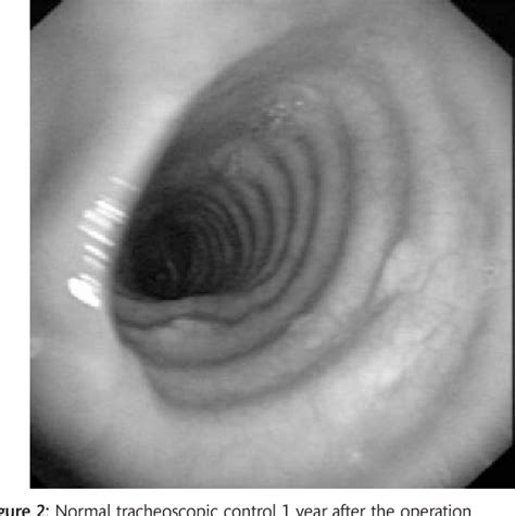 Figure 2 From Tracheal Laceration After Laser Ablation Of Nodular