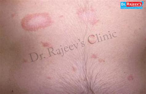 Homeopathy Treatment For Pityriasis Rosasea