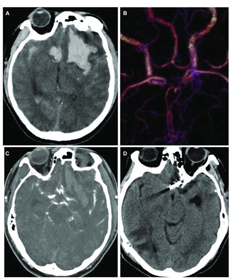 A Computed Tomography Ct Of The Head Showed Subarachnoid Hemorrhage