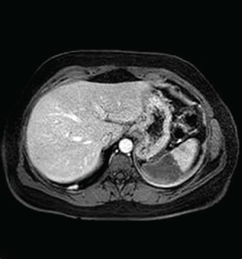 Abdominal Mri Axial T2 Weighted Image A Showing A High Intensity