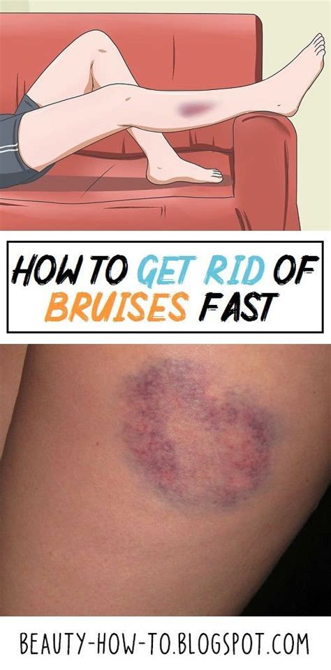 How To Get Rid Of Bruises Fast With Natural Home Remedies Bruises