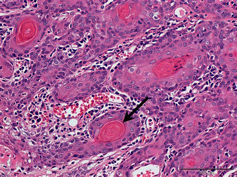 A Tonsillar Squamous Cell Carcinoma In A 6 Year Ol Case Study Cytopath