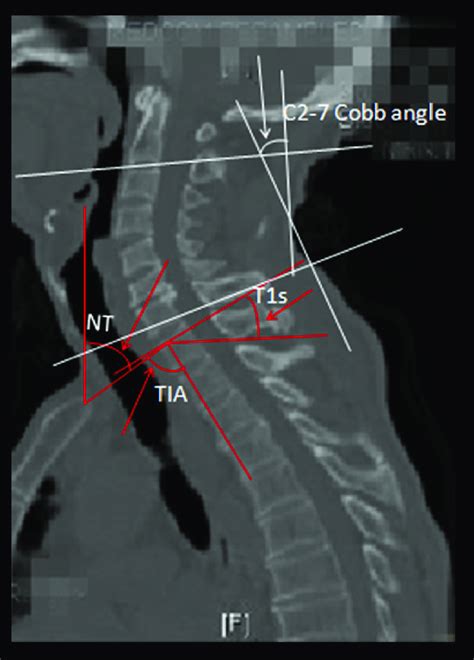 Sagittal Parameters In The Cervical Spine The C2 C7 Cobb Angle Was