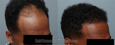 More than 35 million men and 21 million women suffer from hair loss problems within the usa alone, with most of the hair loss being caused by genetic factors. Before and after photos of hair transplant surgery with an ...