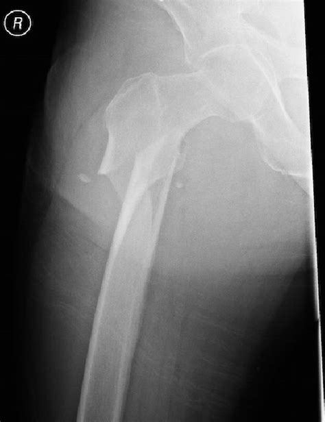Figure Oblique Fracture Of The Proximal Shaft Of The Femur With Severe