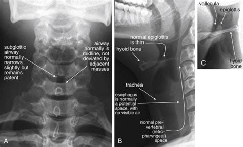 Imaging Soft Tissues Of The Neck Radiology Key